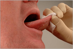 Mouth cancer soft tissue
